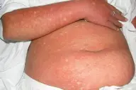 Ban đỏ và chấm xuất huyết (petechiae) trên da bệnh nhân sốt xuất huyết dengue